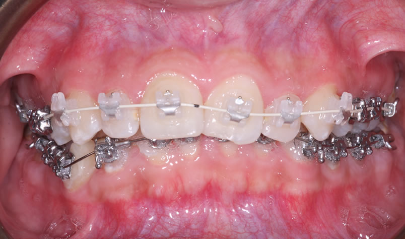ceramic braces ireland tullamore