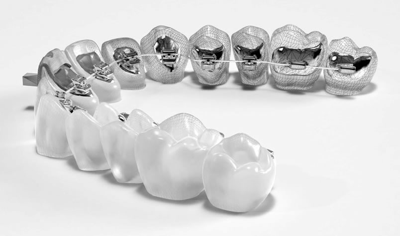 lingual brace irelans
