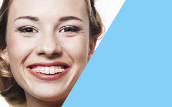 ceramic braces